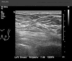 Breast Ultrasound